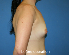 plastic-surgery-breast-augmentation